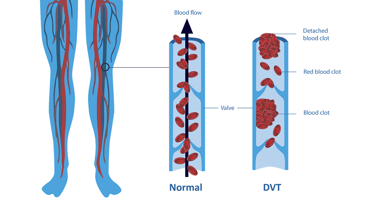 Deep Vein Thrombosis