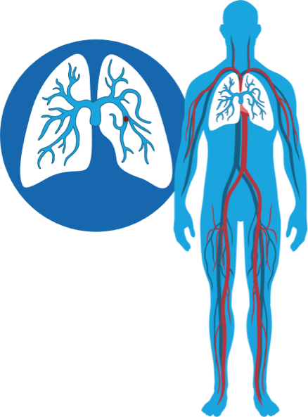 Symptons PE and DVT Symptons PE and DVT